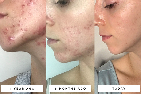 Skin rejuvenation for acne-prone skin