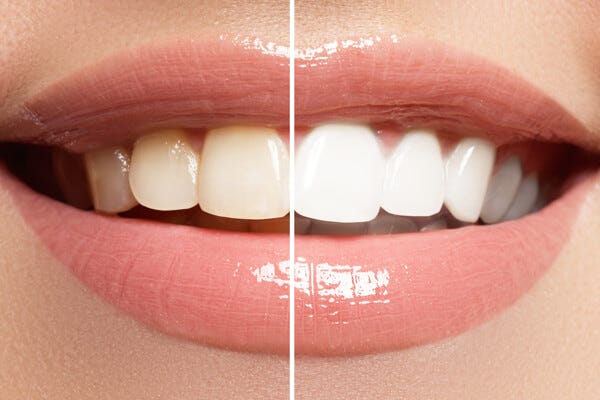 Teeth Whitening 101: Brighten Whiten Your Smile