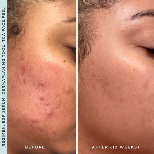 Epidermal growth factor before and after results