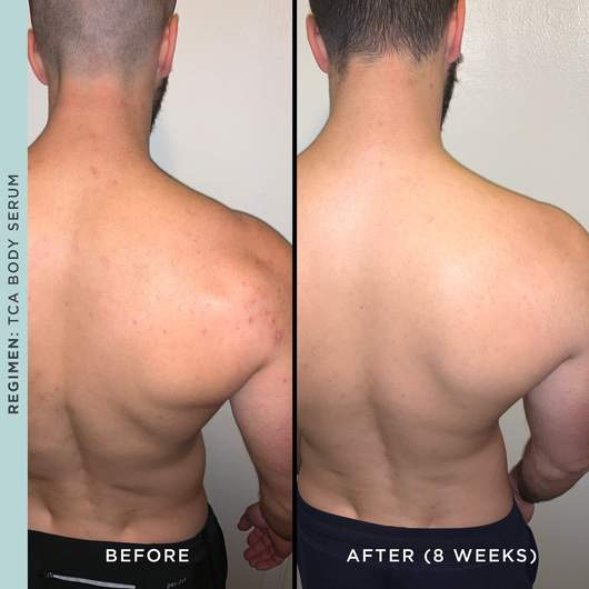 TCA body peel before and after results for a back