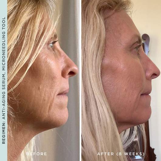 Advanced Retinol before and after results