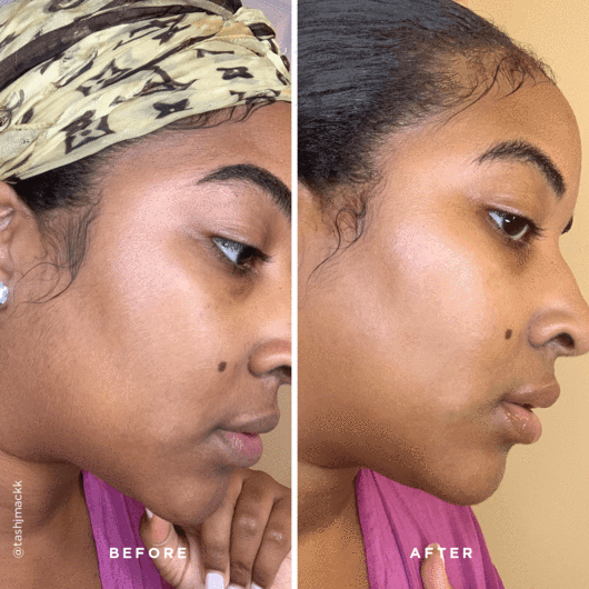 Dermaplaning Exfoliation Tool