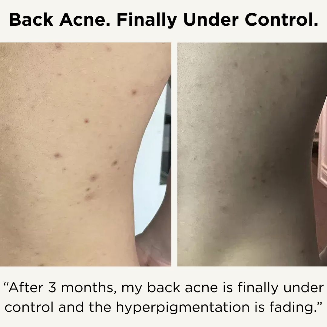 TCA Body Peel