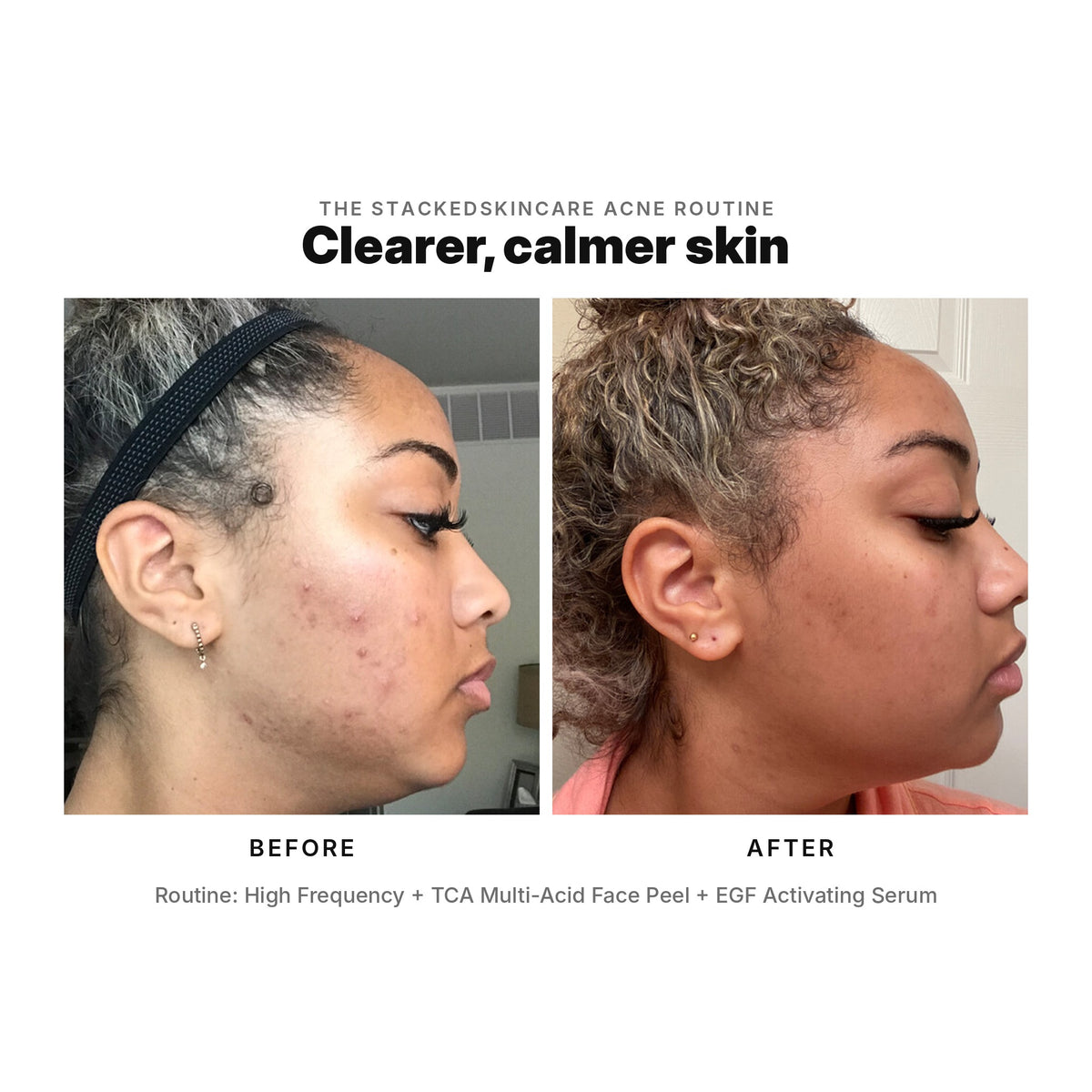Acne before and after: cheek and jaw breakouts cleared with High Frequency, TCA Multi-Acid Face Peel and EGF Activating Serum.