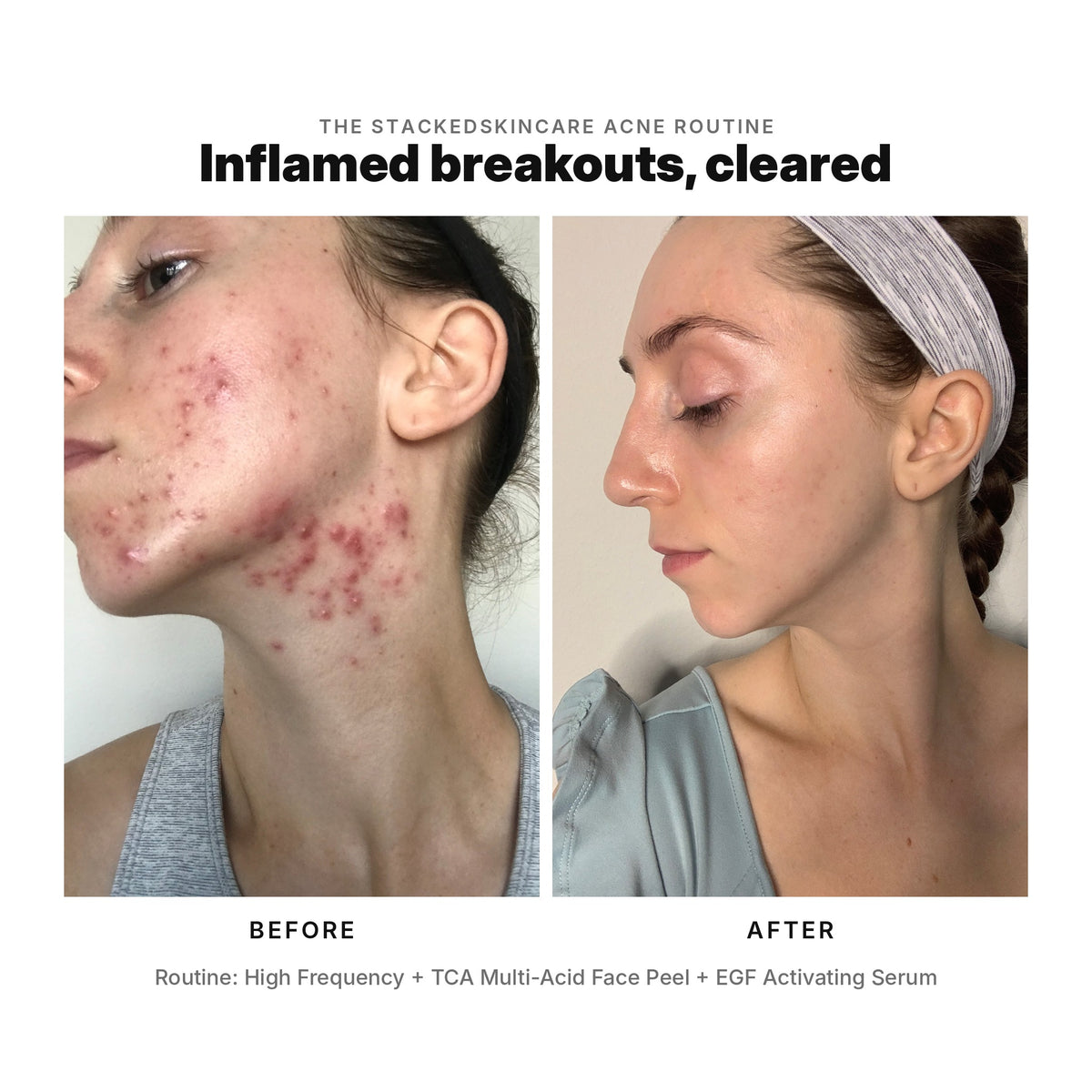 Acne before and after: inflamed breakouts on cheek and jaw cleared with the StackedSkincare acne routine of High Frequency, TCA Face Peel and EGF Activating Serum.