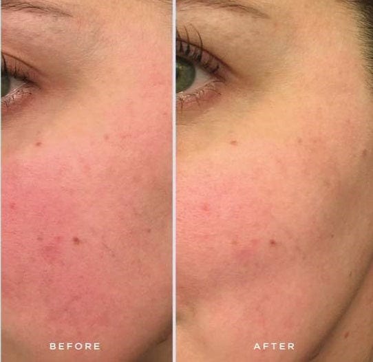 Shiunko Face Oil for facial redness, before and after results