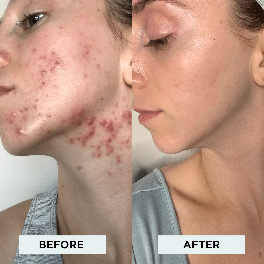 The StackedSkincare Acne System