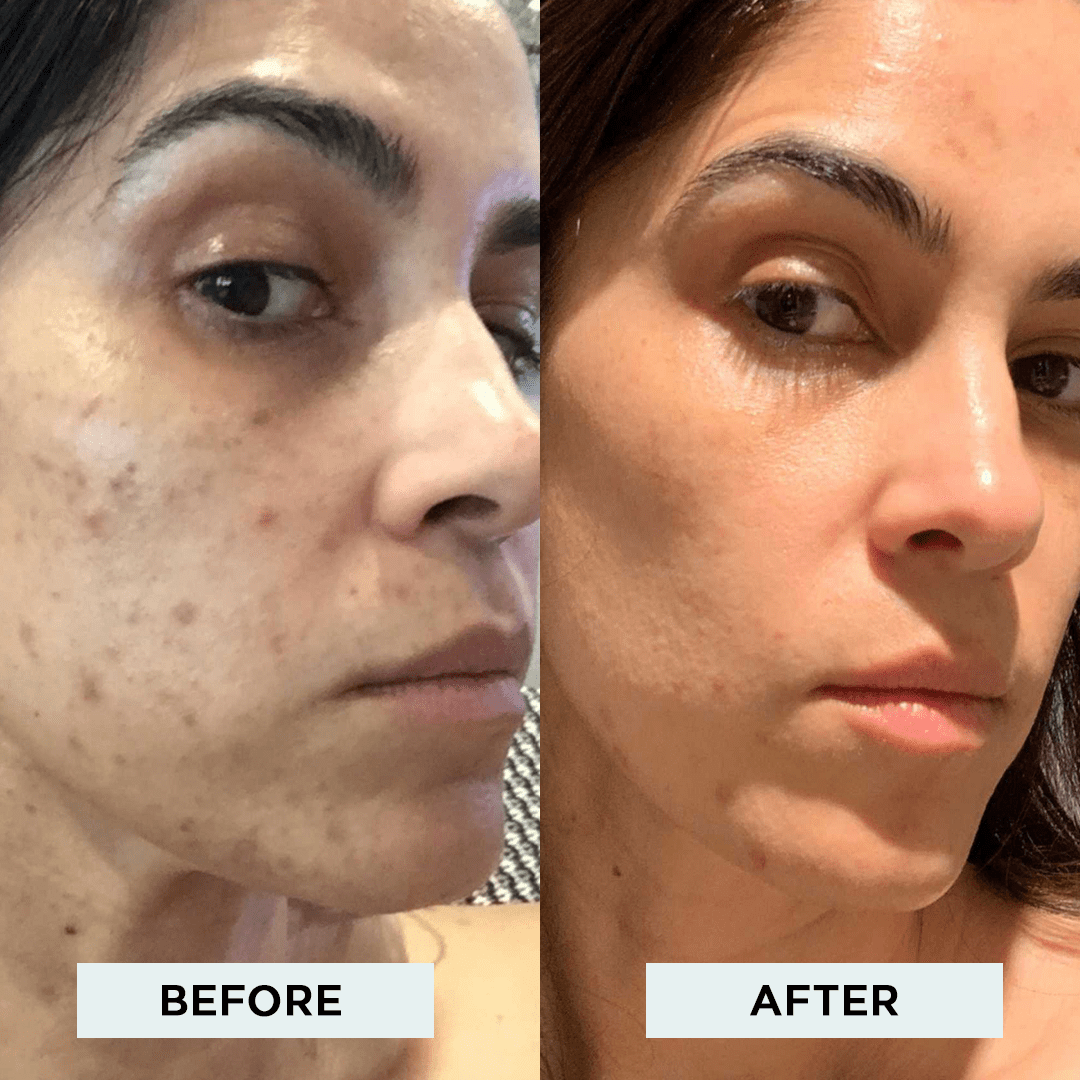 The StackedSkincare Acne System