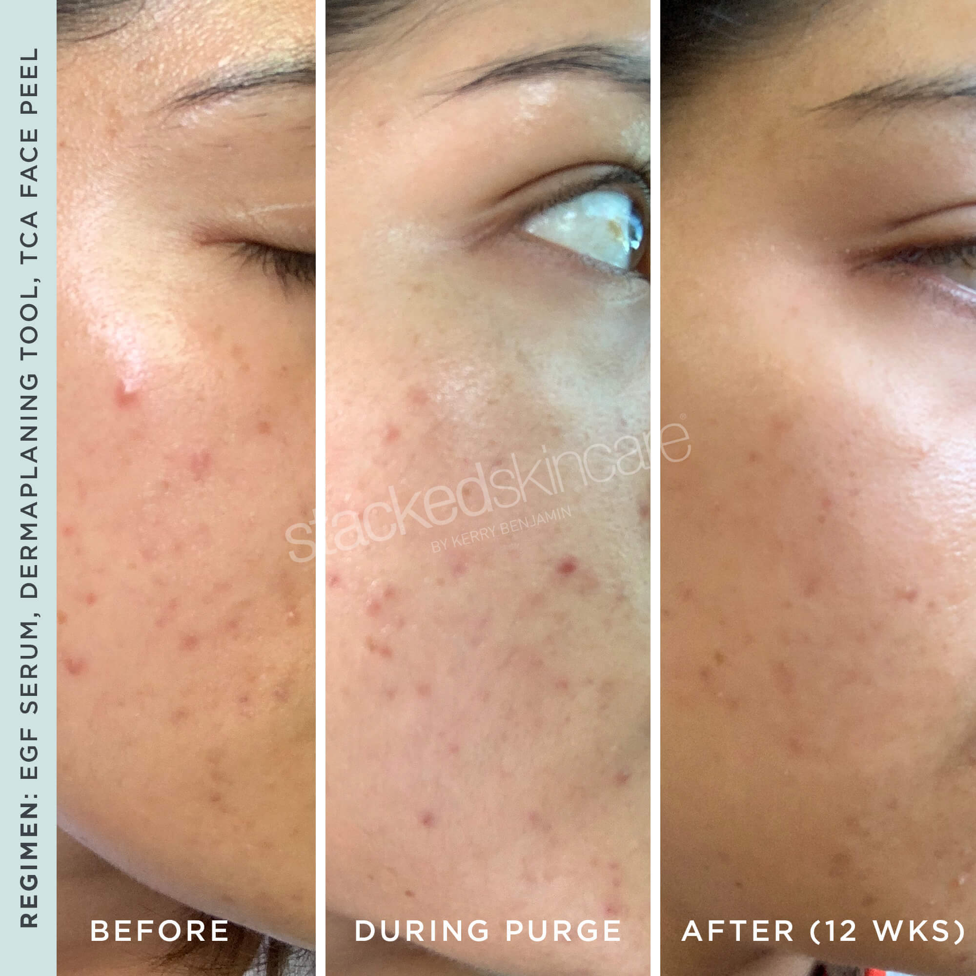 TCA face peel before and after results