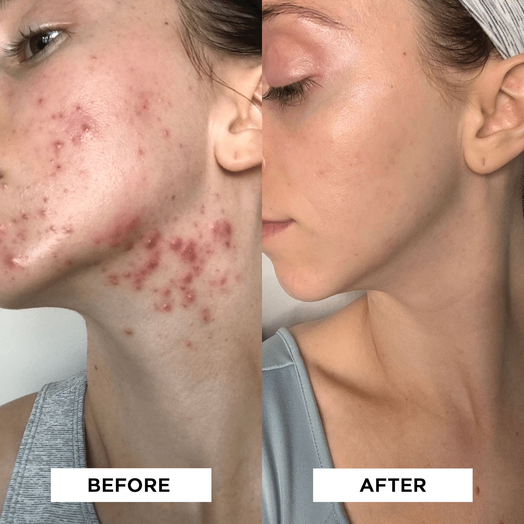 TCA face peel before and after results