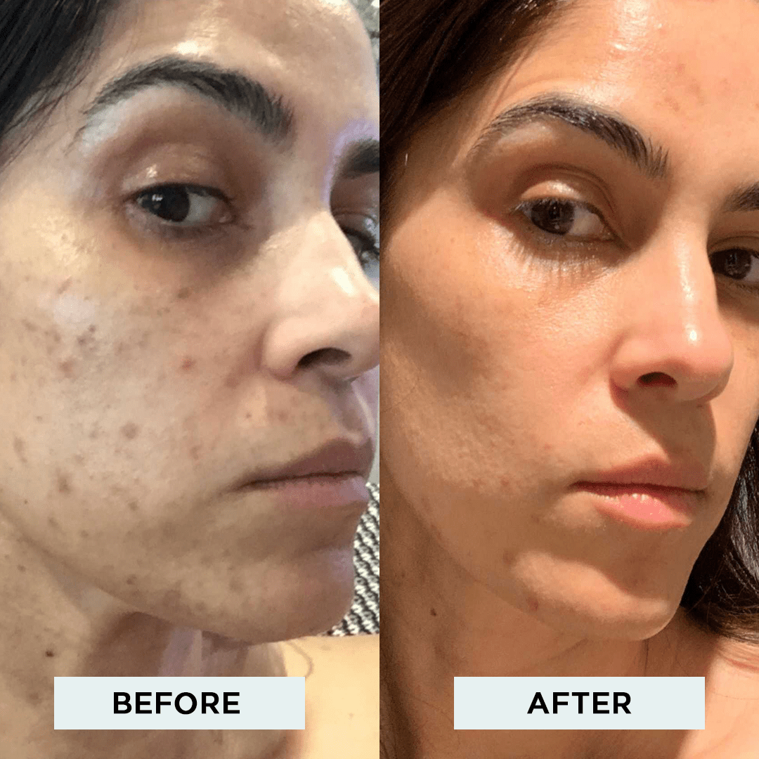 TCA face peel before and after results