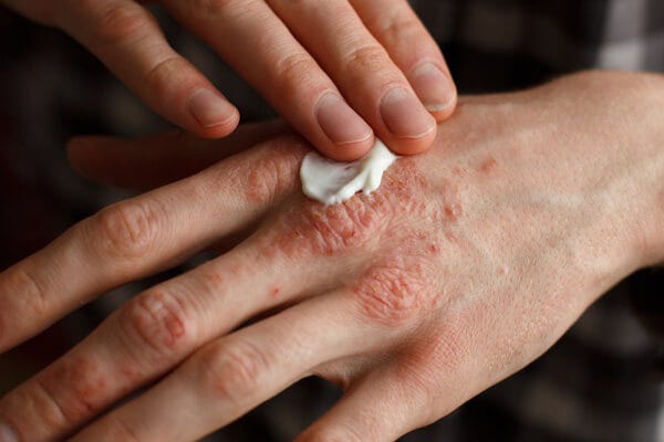 Sensitive Skin 101: Psoriasis, Eczema, And Rosacea