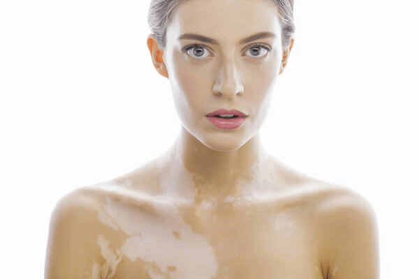 Hypopigmentation: What It Is & How To Treat It