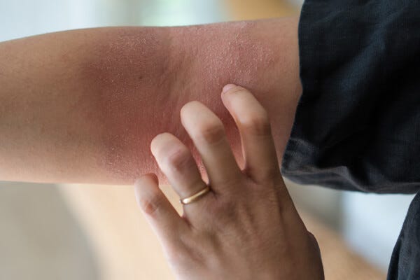 The Scratch Itch Factor : My Top 13 Eczema Tips
