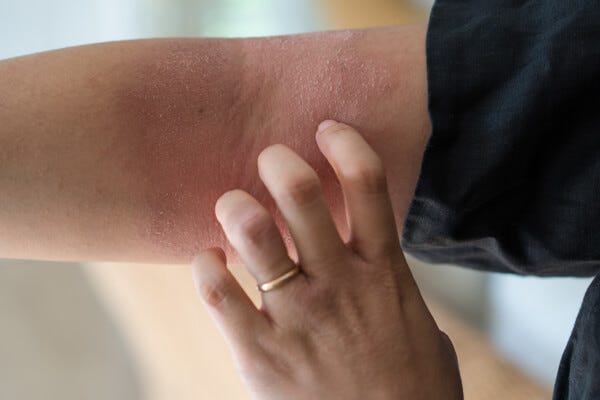 ECZEMA: THE ITCH THAT RASHES (AND HOW TO STOP IT)