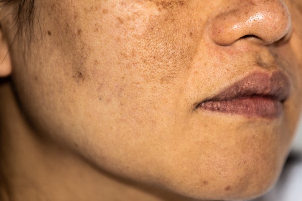 Melasma: What It Is And How To Deal With It