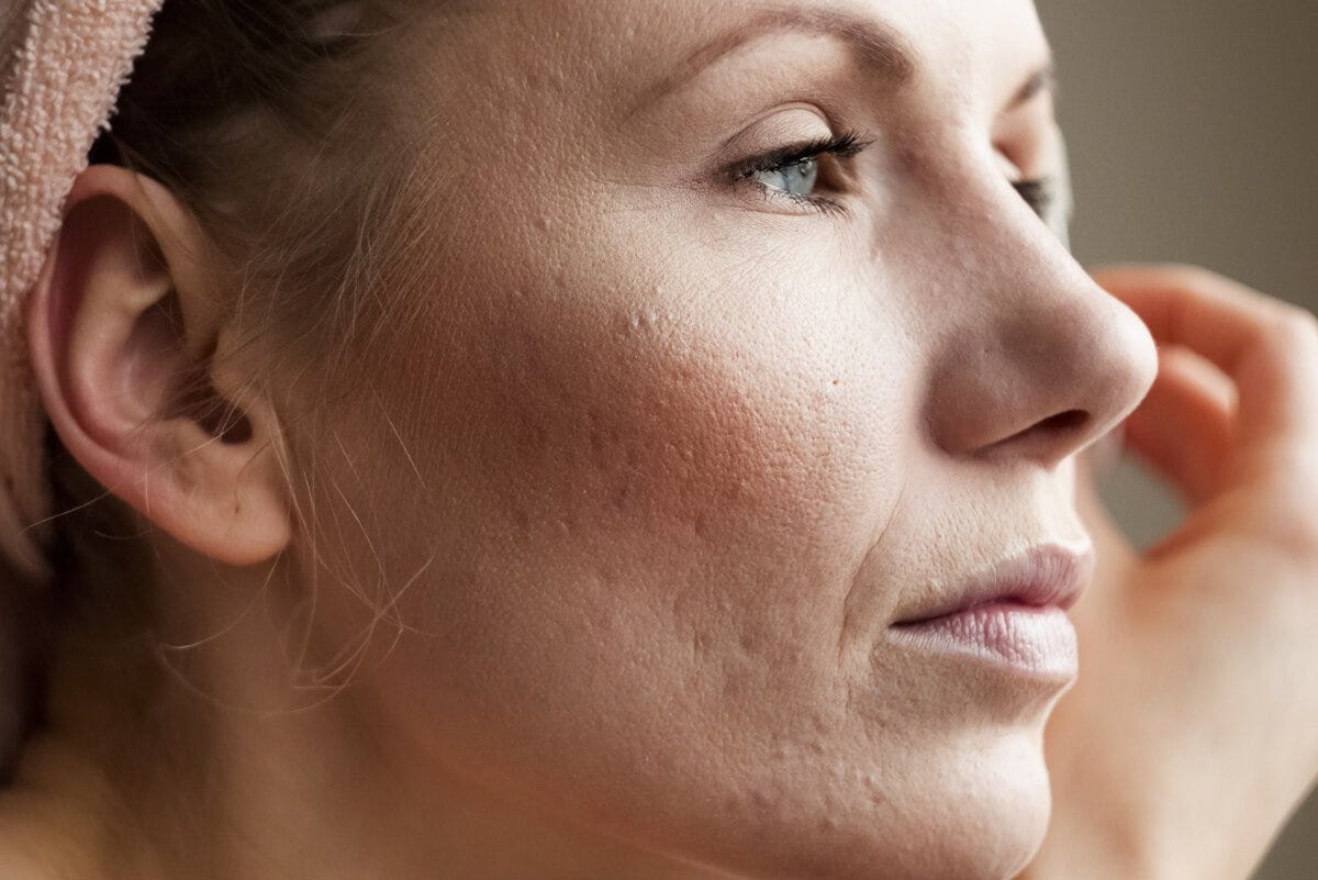 Types Of Acne Scars & How To Treat Them