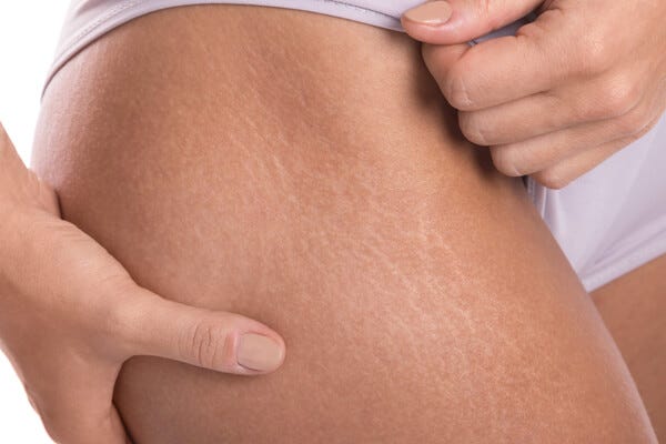 The Stretch Mark Secret