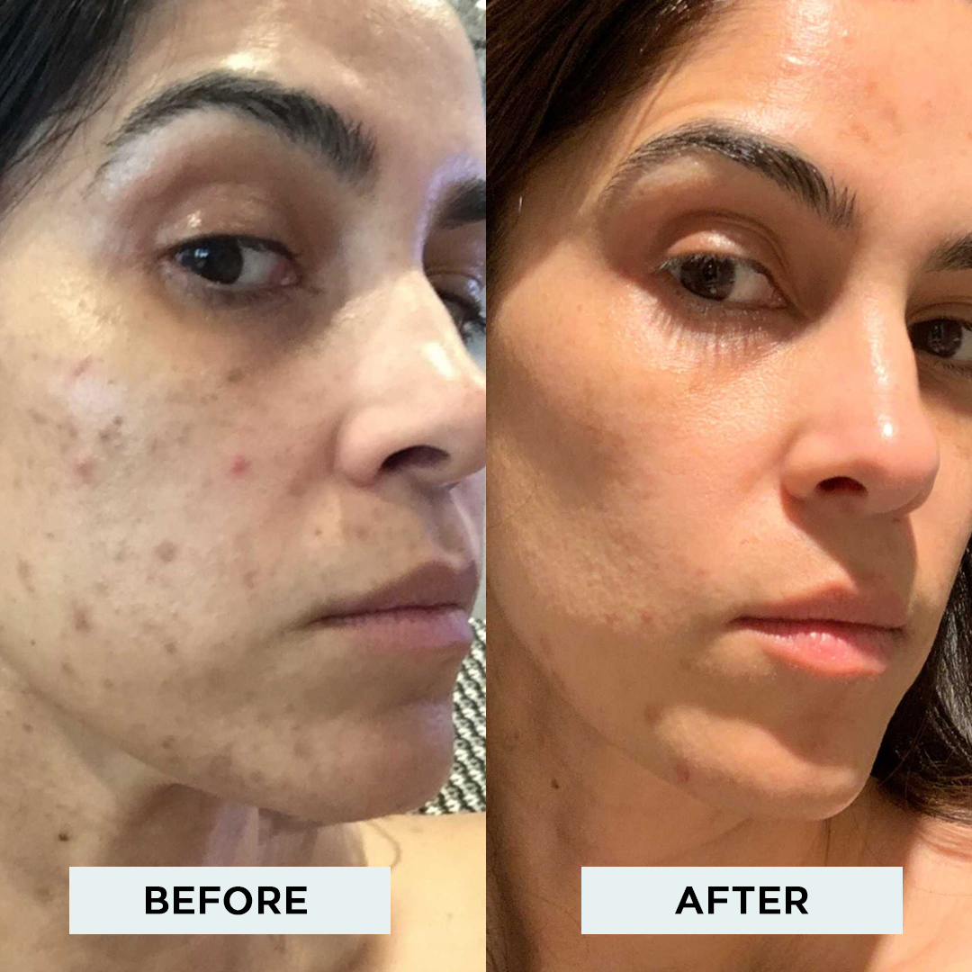 TCA Multi-Acid Face Peel