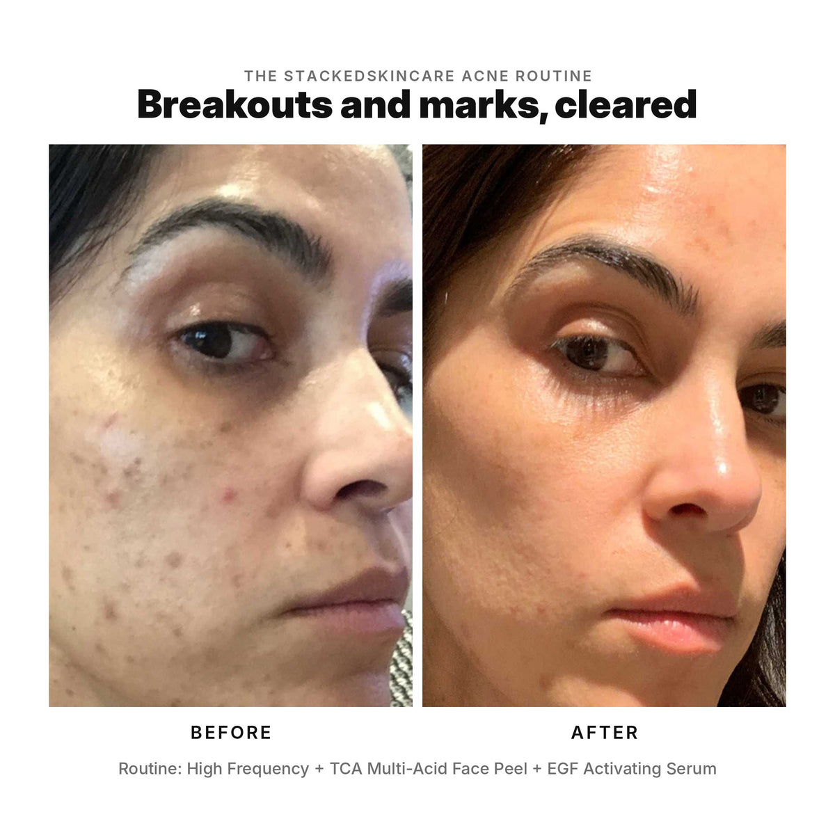 Before and after: breakouts and marks cleared with High Frequency, TCA Multi-Acid Face Peel and EGF Activating Serum.