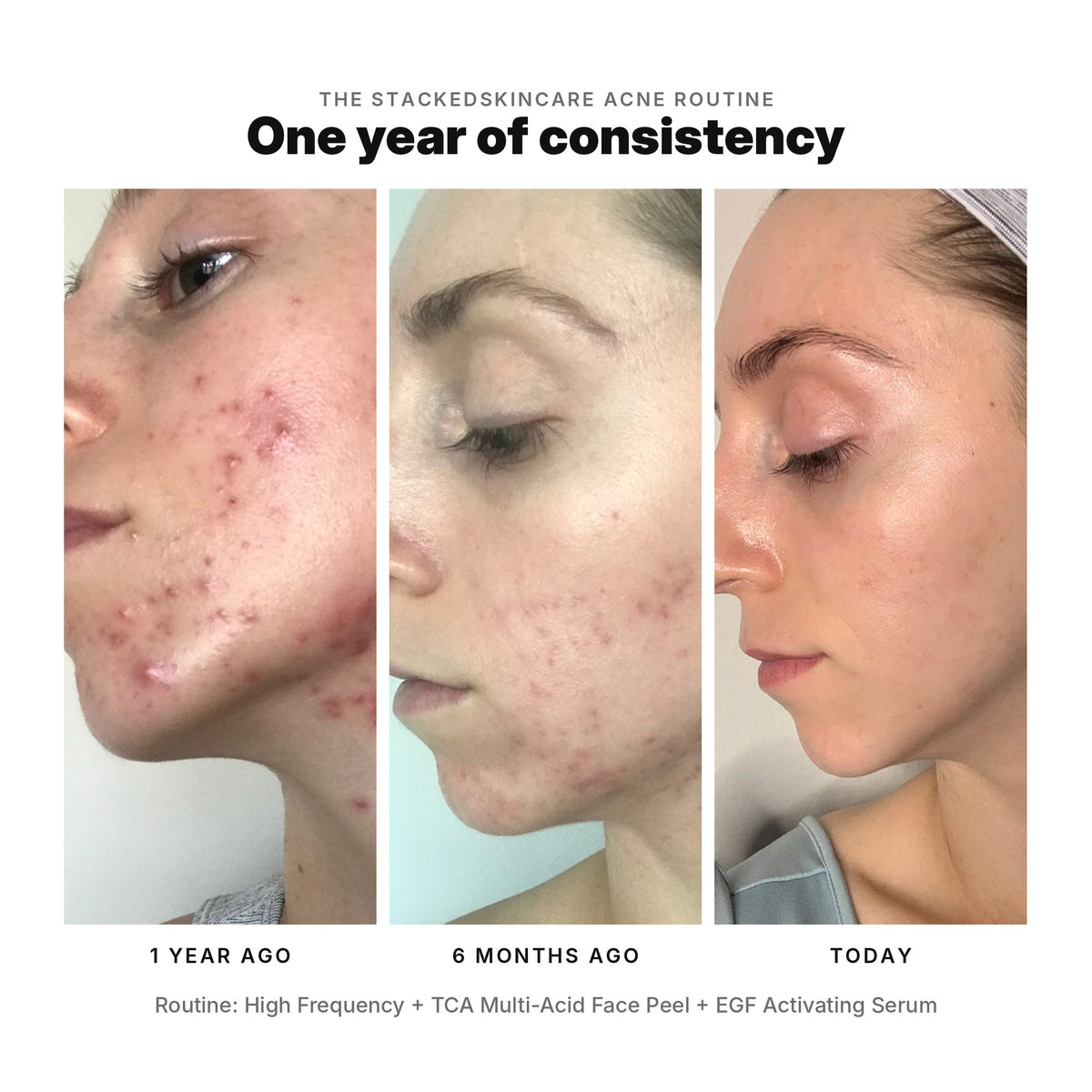 One year of acne progress: 1 year ago, 6 months ago, and today, using High Frequency, TCA Multi-Acid Face Peel and EGF Activating Serum.