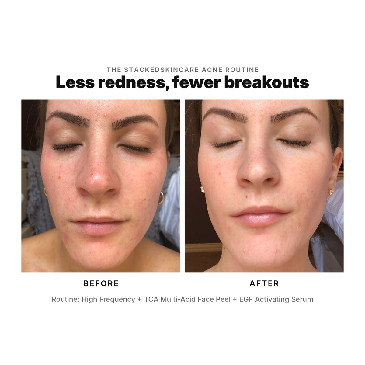 Acne before and after: less redness and fewer breakouts with High Frequency, TCA Multi-Acid Face Peel and EGF Activating Serum.