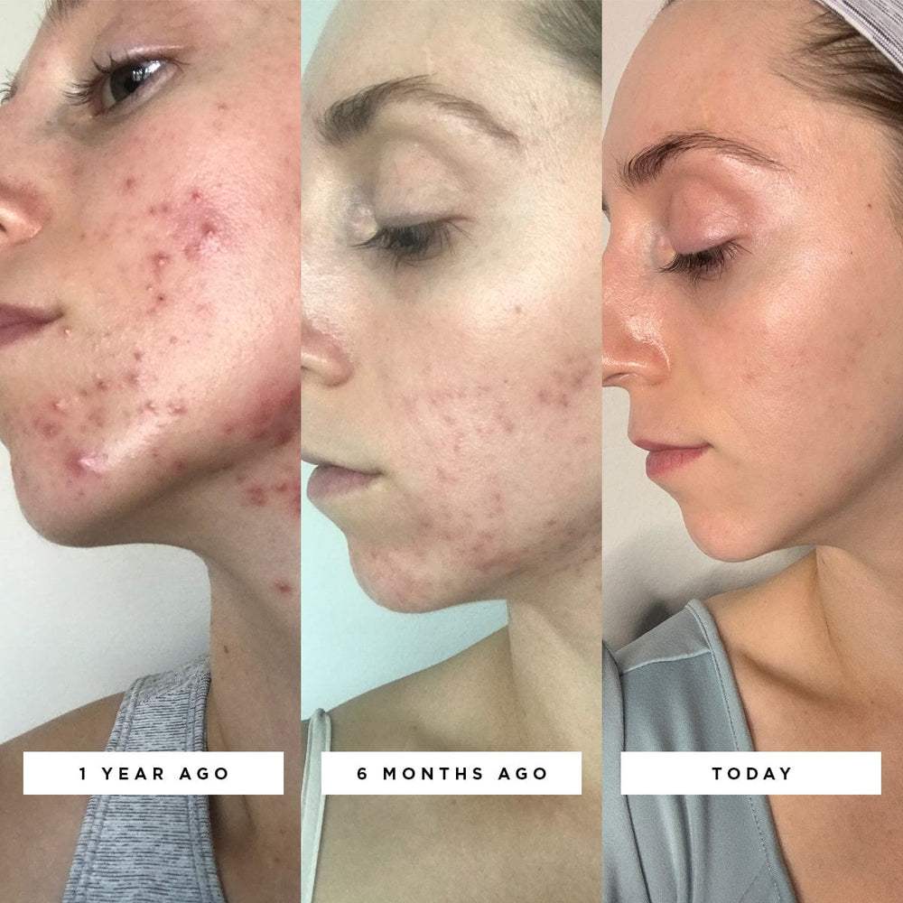 High Frequency Acne Device & Facial Wand StackedSkincare