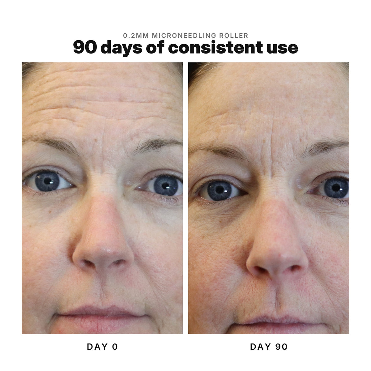 Microneedling before and after: forehead lines at day 0 and day 90 of consistent use with the 0.2mm roller.