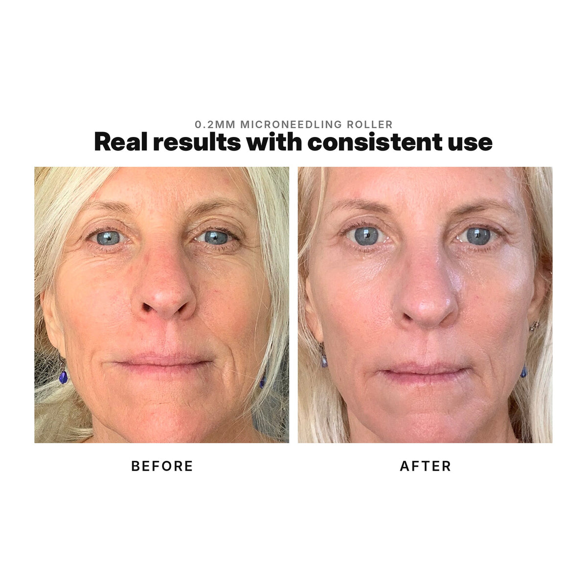 Microneedling before and after: face showing smoother, more even skin with consistent use.