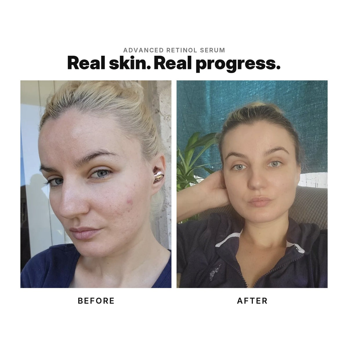 Advanced Retinol Serum before and after showing real skin progress.
