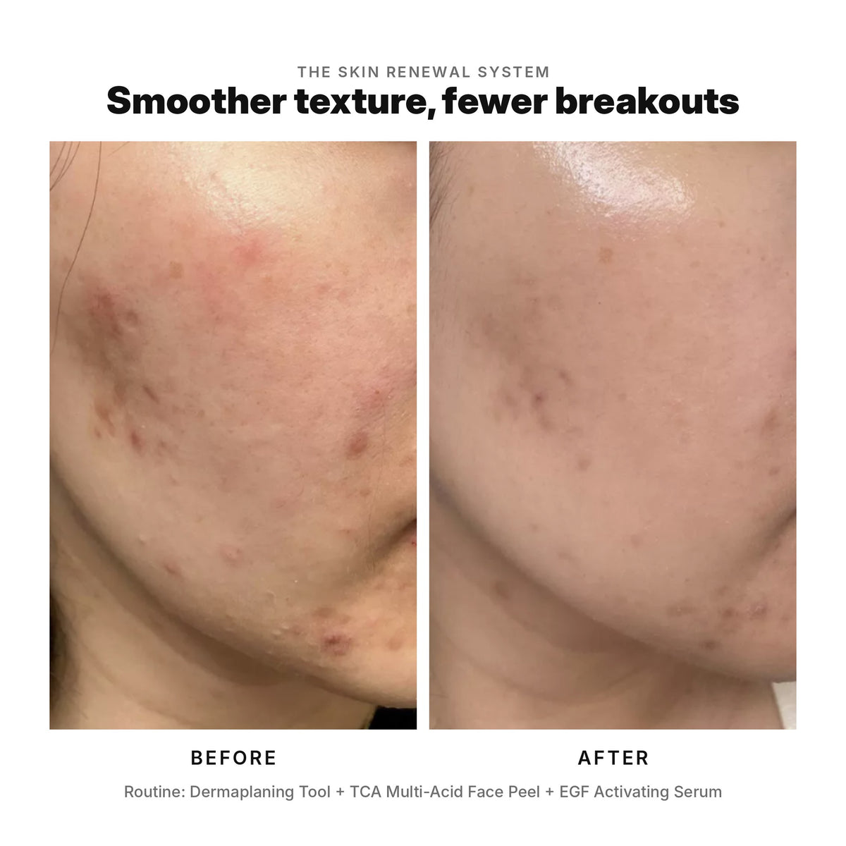 Skin Renewal System before and after: smoother texture and fewer breakouts with the Dermaplaning Tool, TCA Face Peel and EGF Activating Serum.